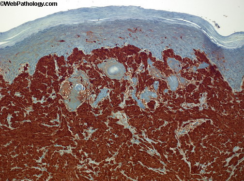 Scrotum_Granular Cell Tumor5_S100.jpg